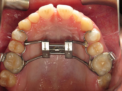 RPE Orthodontics - A Comprehensive Guide to Rapid Palatal Expansion